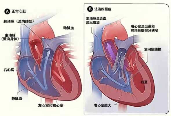 胎儿肺动脉狭窄原因（胎儿肺动脉狭窄原因有哪些）  第2张