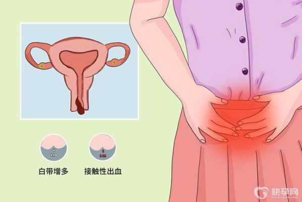 怀孕后宫颈息肉出血怎么办,孕期宫颈息肉反复出血怎么办 第1张 怀孕后宫颈息肉出血怎么办,孕期宫颈息肉反复出血怎么办 第1张
