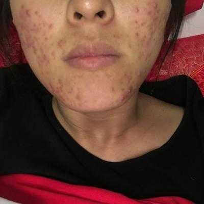 孕期下巴长痘痘生男孩(孕期下巴长痘痘生男孩几率大吗) 第2张 孕期下巴长痘痘生男孩(孕期下巴长痘痘生男孩几率大吗) 第2张
