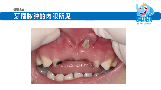 胎儿上牙槽骨(儿童牙齿长在牙龈上) 第2张 胎儿上牙槽骨(儿童牙齿长在牙龈上) 第2张