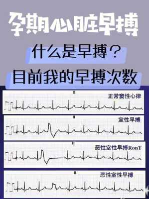 心脏早搏是怎么一回事,怀孕期间心脏早搏怎么办 第1张 心脏早搏是怎么一回事,怀孕期间心脏早搏怎么办 第1张