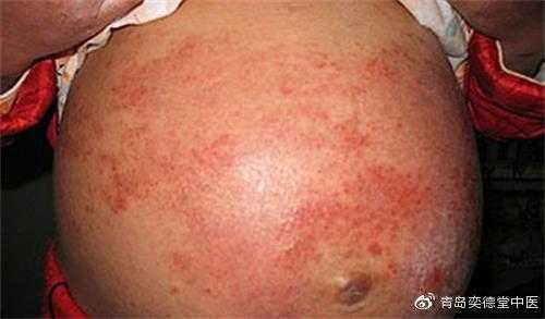 孕期私处湿疹怎么办(阴部湿疹要如何治疗) 第2张 孕期私处湿疹怎么办(阴部湿疹要如何治疗) 第2张