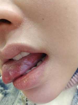 孕期舌头疼怎么办(孕期舌头疼怎么办快速缓解) 第2张 孕期舌头疼怎么办(孕期舌头疼怎么办快速缓解) 第2张