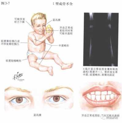 胎儿肱骨短会是侏儒吗（胎儿肱骨短会是侏儒吗）  第2张