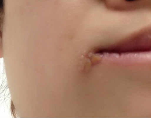 孕妇长疱疹影响胎儿吗(孕中期嘴角长疱疹对胎儿有影响吗) 第3张 孕妇长疱疹影响胎儿吗(孕中期嘴角长疱疹对胎儿有影响吗) 第3张