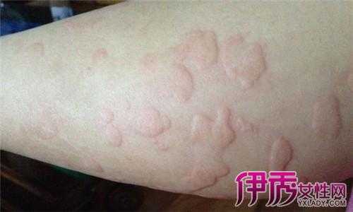 孕期荨麻疹怎样止痒(荨麻疹迅速止痒办法有哪些) 第2张 孕期荨麻疹怎样止痒(荨麻疹迅速止痒办法有哪些) 第2张