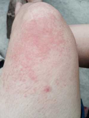 孕妇长湿疹怎么办,孕期湿疹加重怎么办啊 第3张 孕妇长湿疹怎么办,孕期湿疹加重怎么办啊 第3张