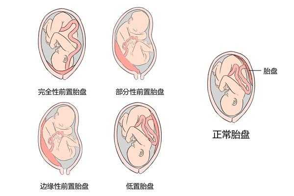 孕期胎盘位置会变吗(孕期胎盘位置会改变吗) 第3张 孕期胎盘位置会变吗(孕期胎盘位置会改变吗) 第3张