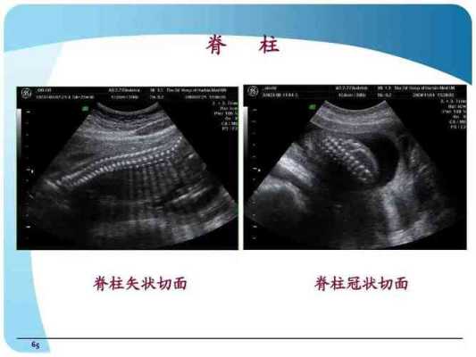 胎儿脊柱呈串珠样排列(胎儿脊柱呈串珠样排列是什么意思) 第2张 胎儿脊柱呈串珠样排列(胎儿脊柱呈串珠样排列是什么意思) 第2张