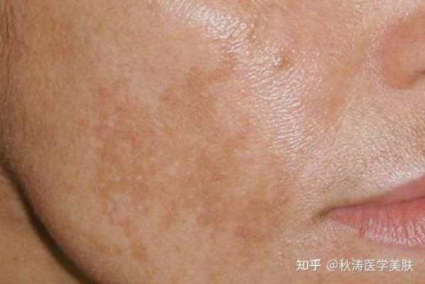孕期脸上的斑怎么去除(孕期脸上的斑怎么去除小妙招) 第2张 孕期脸上的斑怎么去除(孕期脸上的斑怎么去除小妙招) 第2张