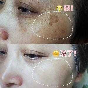 孕期脸上的斑怎么去除(孕期脸上的斑怎么去除小妙招) 第1张 孕期脸上的斑怎么去除(孕期脸上的斑怎么去除小妙招) 第1张