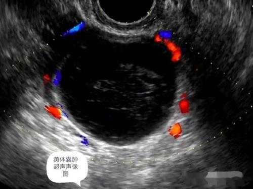 囊肿怀孕会影响胎儿吗(囊肿怀孕会影响胎儿吗) 第1张 囊肿怀孕会影响胎儿吗(囊肿怀孕会影响胎儿吗) 第1张