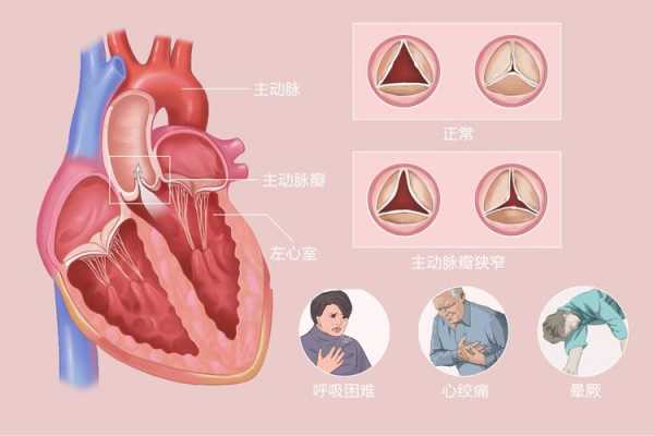 主动脉狭窄怎么回事,胎儿心脏主动脉狭窄严重吗 第2张 主动脉狭窄怎么回事,胎儿心脏主动脉狭窄严重吗 第2张
