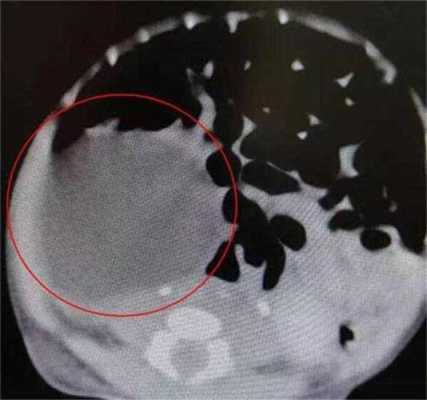 胎儿腹部囊性包块(胎儿腹部囊性包块是什么导致) 第1张 胎儿腹部囊性包块(胎儿腹部囊性包块是什么导致) 第1张