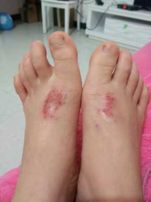 孕期湿疹是如何引起的(孕妇脚上会有湿疹是怎么回事) 第2张 孕期湿疹是如何引起的(孕妇脚上会有湿疹是怎么回事) 第2张