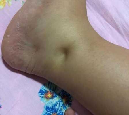 孕期水肿什么时候消失(孕期水肿什么时候消失正常) 第2张 孕期水肿什么时候消失(孕期水肿什么时候消失正常) 第2张
