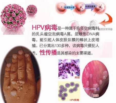 尖锐湿庞影响胎儿吗(尖锐湿庞对胎儿的影响) 第1张 尖锐湿庞影响胎儿吗(尖锐湿庞对胎儿的影响) 第1张