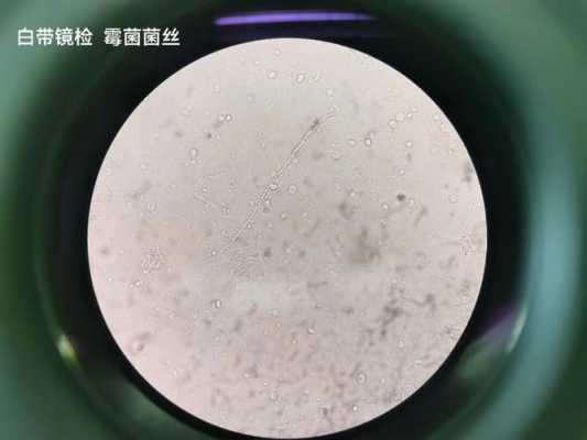 孕期有霉菌影响胎儿吗(孕期有霉菌影响胎儿吗) 第2张 孕期有霉菌影响胎儿吗(孕期有霉菌影响胎儿吗) 第2张