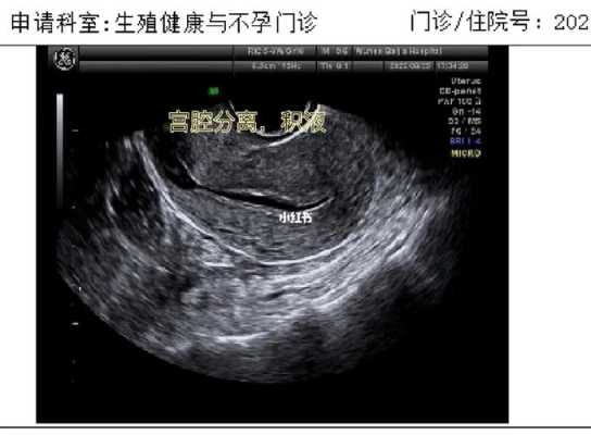 孕期宫腔积液怎么排出(孕期宫腔积液) 第1张 孕期宫腔积液怎么排出(孕期宫腔积液) 第1张