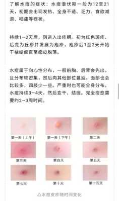 孕期长水痘怎么办(孕妇水痘要终止妊娠吗) 第1张 孕期长水痘怎么办(孕妇水痘要终止妊娠吗) 第1张