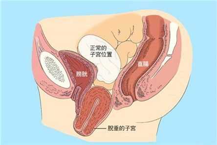 孕期子宫下垂能顺产吗(孕期子宫下垂能顺产吗有危险吗) 第1张 孕期子宫下垂能顺产吗(孕期子宫下垂能顺产吗有危险吗) 第1张