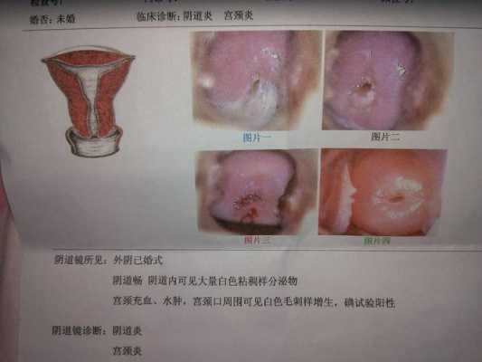 孕期宫颈出血怎么回事(孕期宫颈充血有炎症,一直出血怎么办) 第2张 孕期宫颈出血怎么回事(孕期宫颈充血有炎症,一直出血怎么办) 第2张