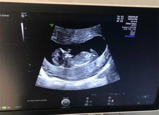 孕期如何检查双性胎儿(一个水晶宝宝能生几个) 第1张 孕期如何检查双性胎儿(一个水晶宝宝能生几个) 第1张