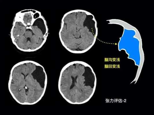 蛛网膜囊肿手术风险大吗?如果不动手术会有什么后果,胎儿蛛网膜囊肿严重吗会影响以后 第1张 蛛网膜囊肿手术风险大吗?如果不动手术会有什么后果,胎儿蛛网膜囊肿严重吗会影响以后 第1张