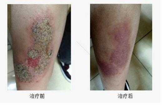 小腿皮炎湿疹怎么治,孕期小腿湿疹怎么办啊 第2张 小腿皮炎湿疹怎么治,孕期小腿湿疹怎么办啊 第2张