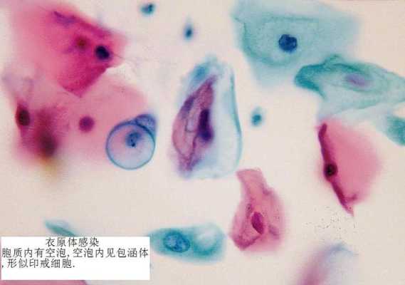衣原体对胎儿有影响吗(衣原体对胎儿有影响吗会传染吗) 第1张 衣原体对胎儿有影响吗(衣原体对胎儿有影响吗会传染吗) 第1张