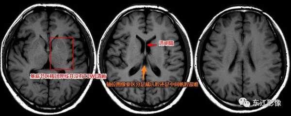 中间帆腔影响智商吗,胎儿中间帆腔正常值是多少 第3张 中间帆腔影响智商吗,胎儿中间帆腔正常值是多少 第3张