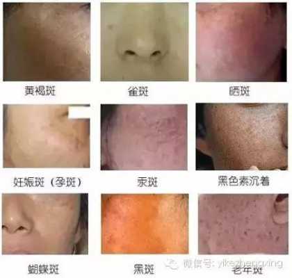 孕期黑色素沉淀严重(皮肤黑色素沉淀怎么办?有什么办法可以去除的) 第3张 孕期黑色素沉淀严重(皮肤黑色素沉淀怎么办?有什么办法可以去除的) 第3张