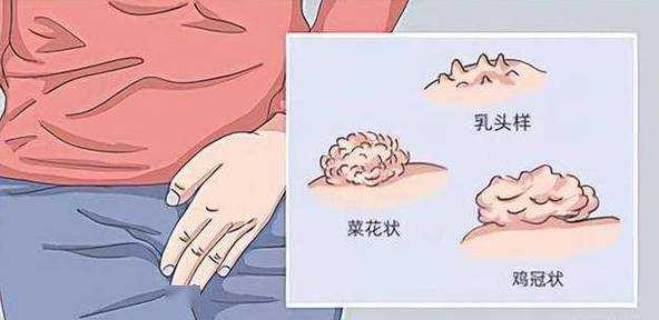 请问我怀孕时患有尖锐湿疣,顺产了宝宝,宝宝会被传染吗, 第1张 请问我怀孕时患有尖锐湿疣,顺产了宝宝,宝宝会被传染吗, 第1张