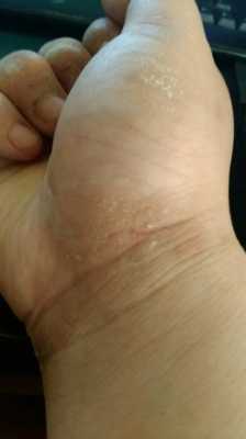 手背上有湿疹怎么办,孕期手背湿疹怎么办啊 第2张 手背上有湿疹怎么办,孕期手背湿疹怎么办啊 第2张