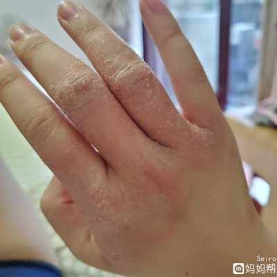 手背上有湿疹怎么办,孕期手背湿疹怎么办啊 第1张 手背上有湿疹怎么办,孕期手背湿疹怎么办啊 第1张