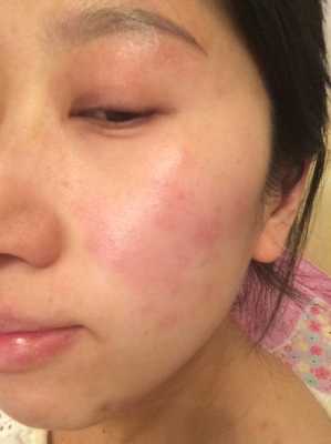 孕期皮炎是怎么引起的（孕妇皮炎怎么引起的）  第2张