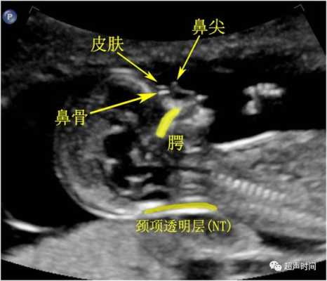 24周胎儿鼻骨正常值(24周胎儿鼻骨长度标准) 第2张 24周胎儿鼻骨正常值(24周胎儿鼻骨长度标准) 第2张