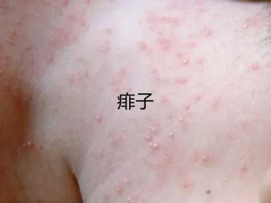 孕期为什么容易得湿疹(孕妇出湿疹怎么办) 第2张 孕期为什么容易得湿疹(孕妇出湿疹怎么办) 第2张