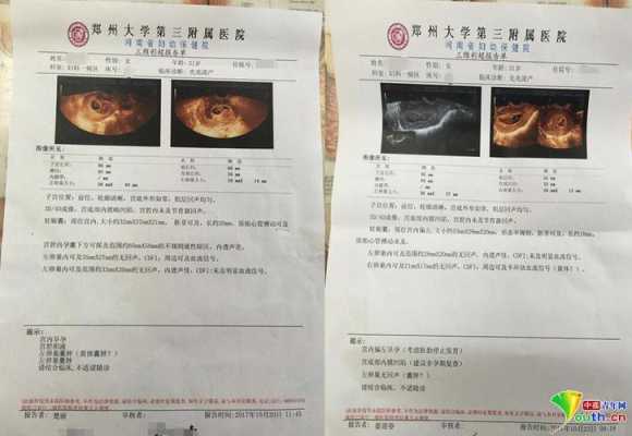 一般多长时间做一次B超比较好,孕期多少次b超合适检查 第2张 一般多长时间做一次B超比较好,孕期多少次b超合适检查 第2张