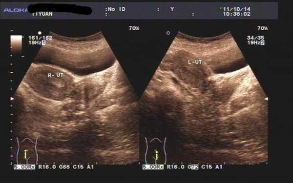 子宫双附件是什么,双子宫胎儿都比较小吗正常吗 第2张 子宫双附件是什么,双子宫胎儿都比较小吗正常吗 第2张
