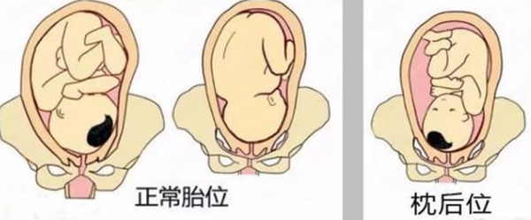 胎儿双顶径96能顺产吗(胎儿双顶径96能顺产吗视频) 第1张 胎儿双顶径96能顺产吗(胎儿双顶径96能顺产吗视频) 第1张