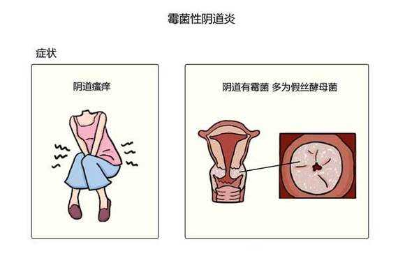 孕期一直霉菌快要生了（孕期一直霉菌快要生了怎么办）  第2张