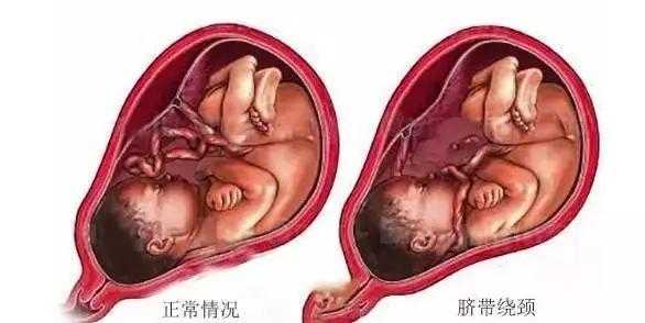 胎儿入盆后还会有胎动吗（胎儿入盆了还会脐带绕颈吗）  第1张