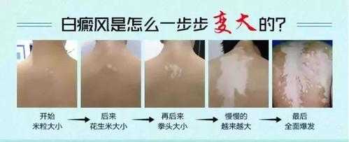 白癜风具有遗传性吗,自癜风能在孕期自愈吗女性 第3张 白癜风具有遗传性吗,自癜风能在孕期自愈吗女性 第3张