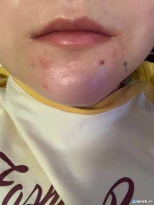 孕期下巴长痘是男孩吗(孕期下巴长痘是男孩吗) 第2张 孕期下巴长痘是男孩吗(孕期下巴长痘是男孩吗) 第2张