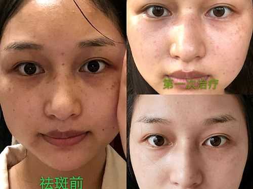 小女孩脸上长斑应该怎么办,孕期脸上长斑生男生女怎么办 第1张 小女孩脸上长斑应该怎么办,孕期脸上长斑生男生女怎么办 第1张
