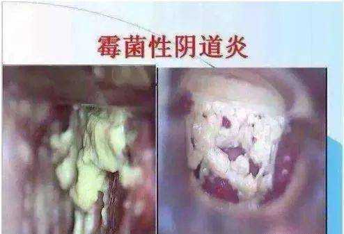 霉菌性阴道炎对胎儿有影响吗(白带念珠菌对胎儿的影响) 第1张 霉菌性阴道炎对胎儿有影响吗(白带念珠菌对胎儿的影响) 第1张