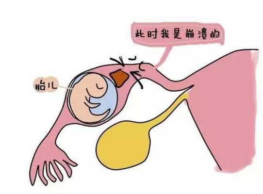 宫腔内出血什么原因,孕期宫内出血的原因有哪些 第1张 宫腔内出血什么原因,孕期宫内出血的原因有哪些 第1张