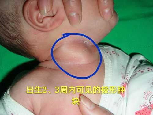 胎儿颈部畸形（胎儿颈部畸形）  第1张