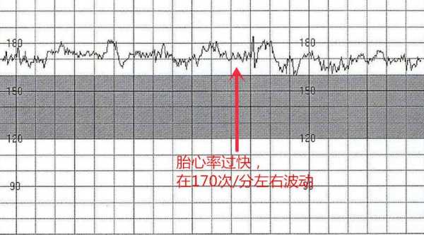 胎心监护多少分正常, 第1张 胎心监护多少分正常, 第1张